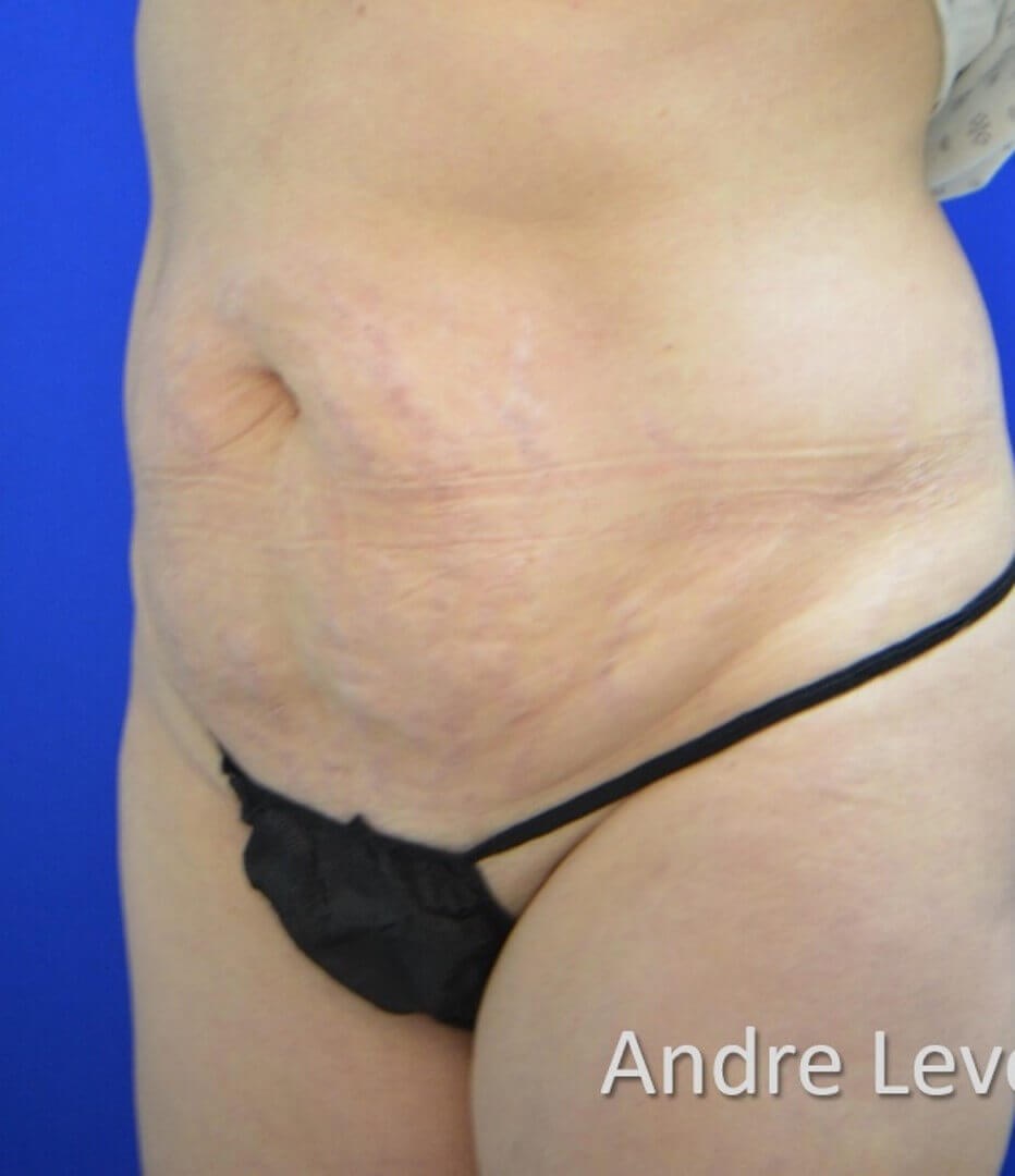 Lipoabdominoplasty Oblique Vie Before