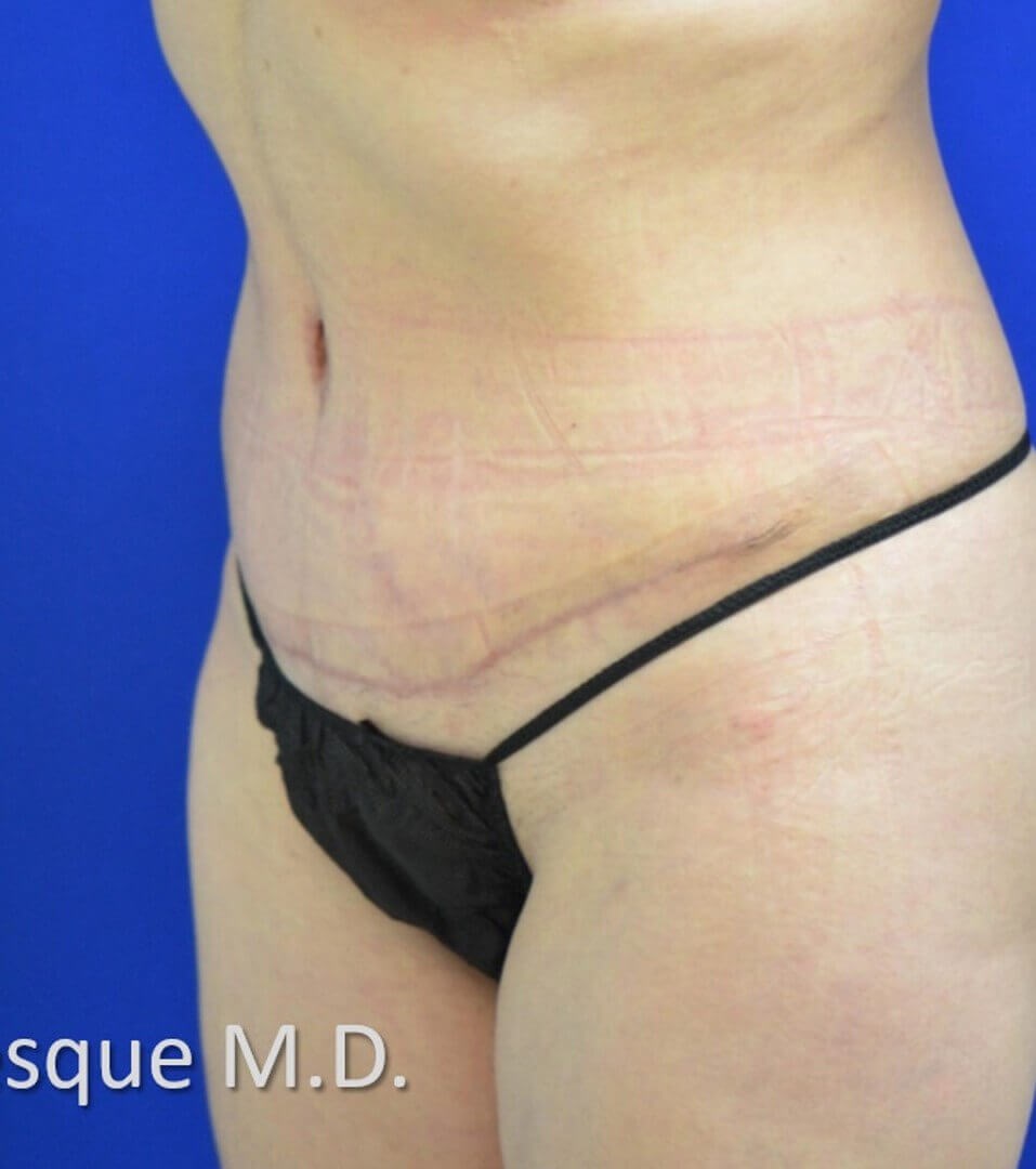 Lipoabdominoplasty Oblique Vie After