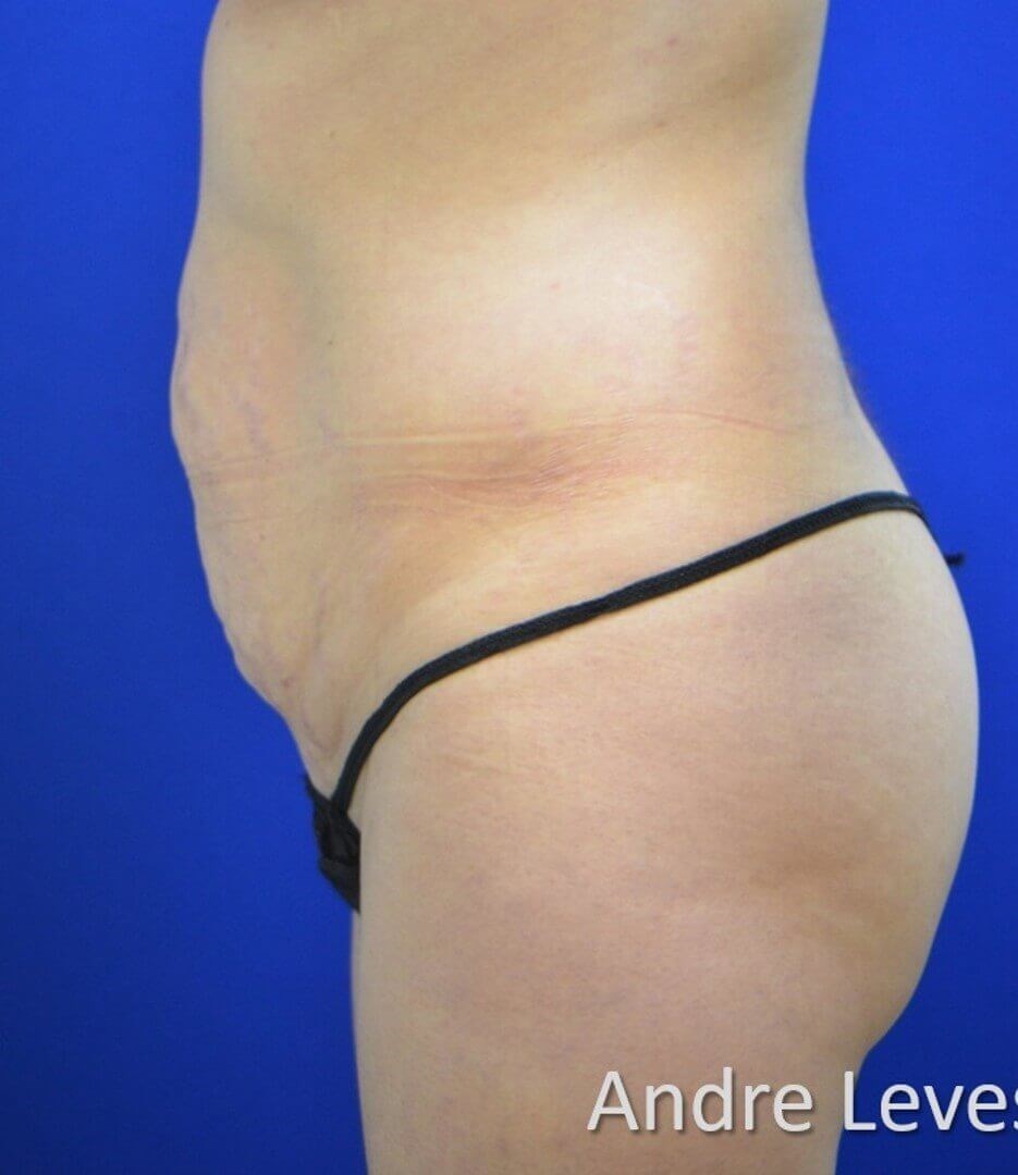 Lipoabdominoplasty Side View Before