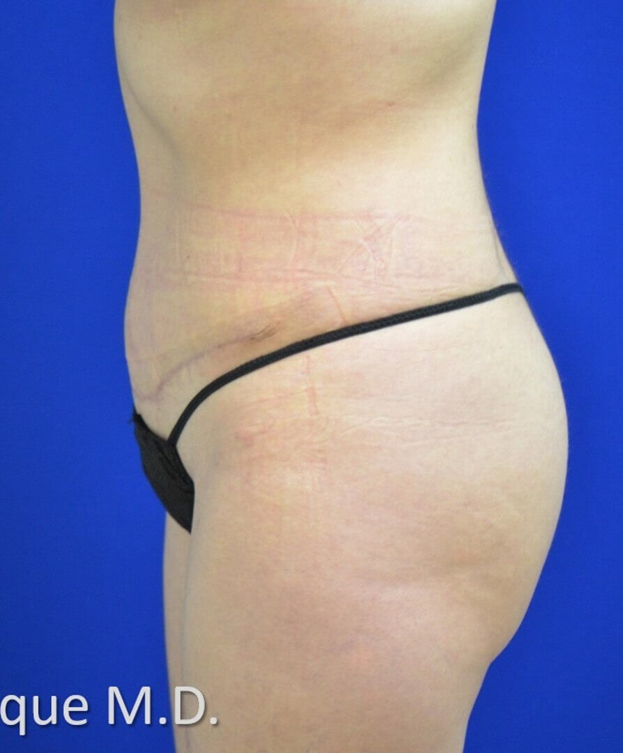 Lipoabdominoplasty Side View After