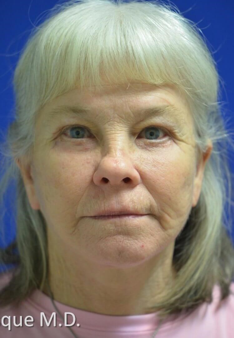 Full facial rejuvenation After