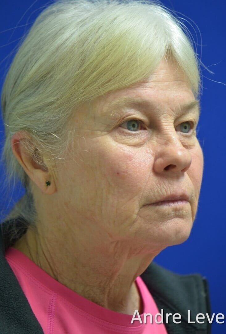 Full facial rejuvenation Before