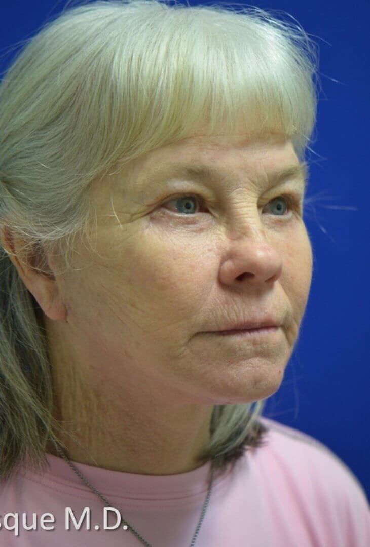 Full facial rejuvenation After