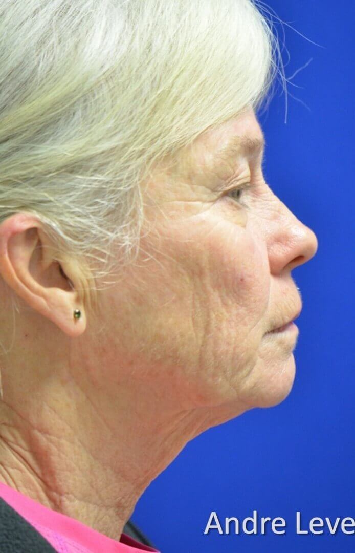 Full facial rejuvenation Before