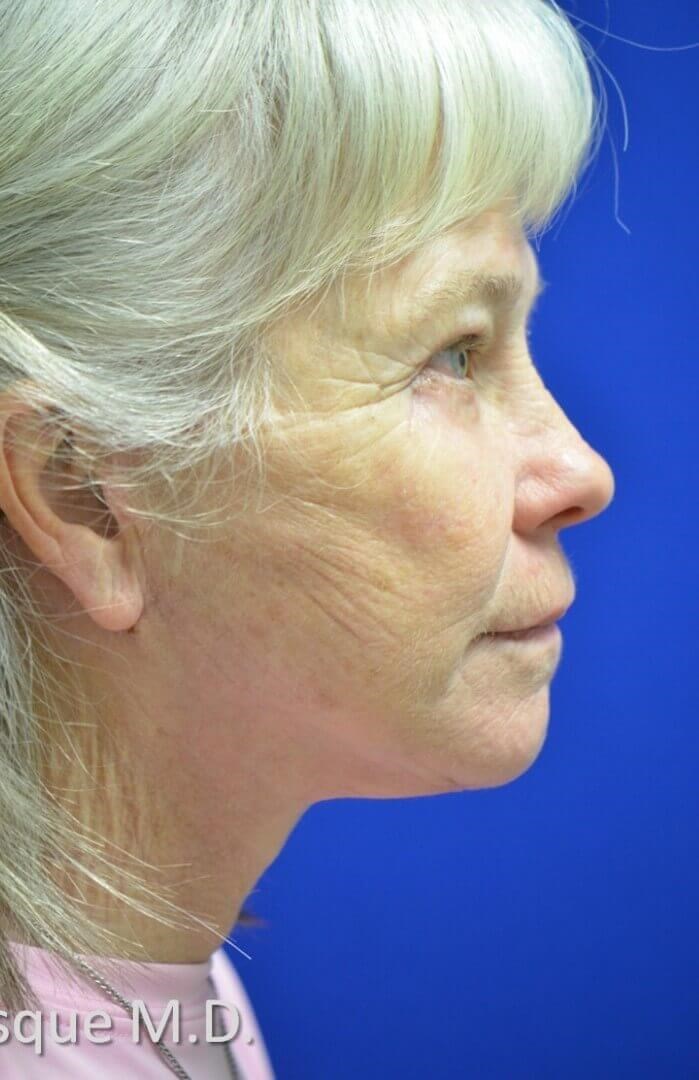 Full facial rejuvenation After
