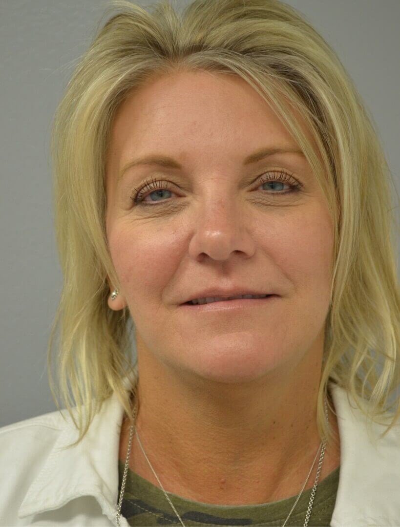 Face and Necklift After