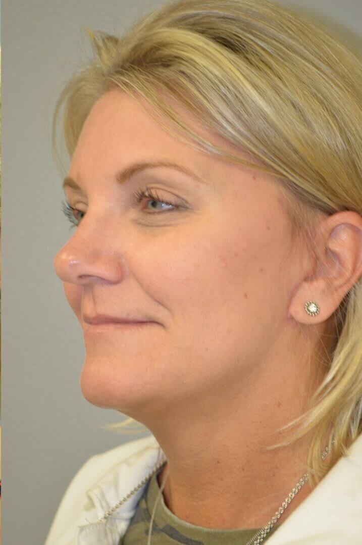 Face and Necklift After