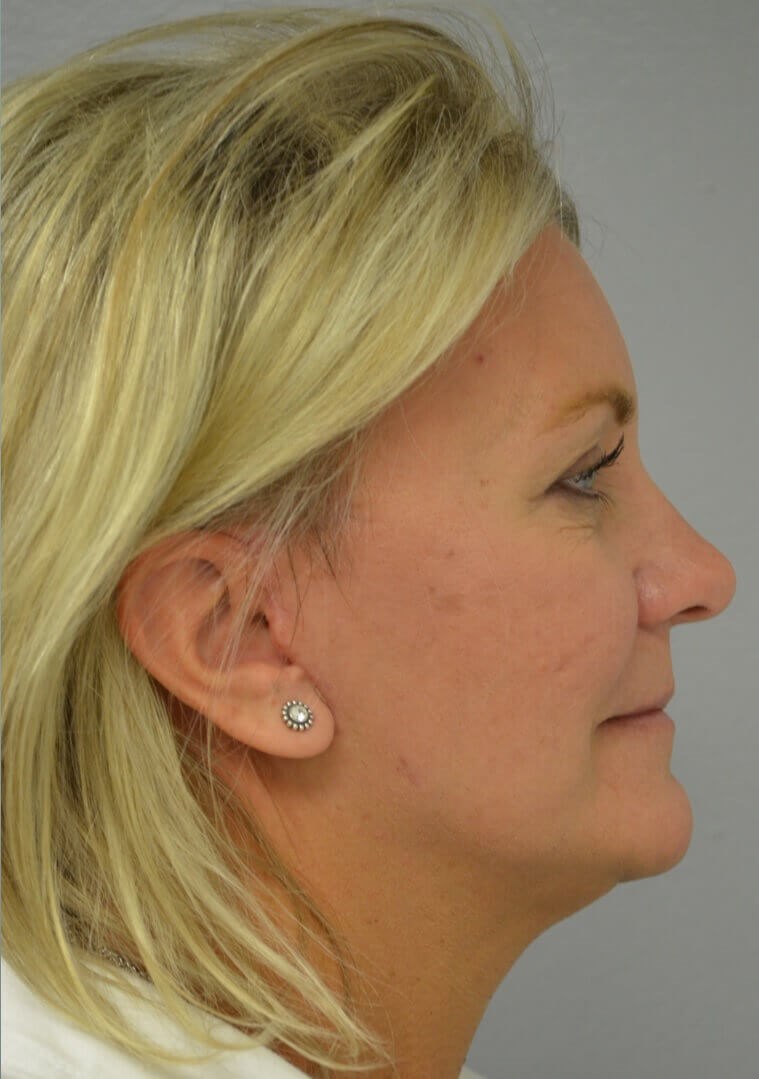 Face and Necklift After