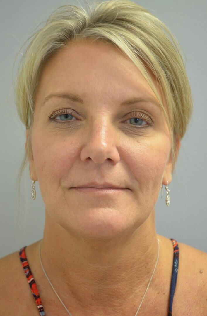 Face and Necklift Before