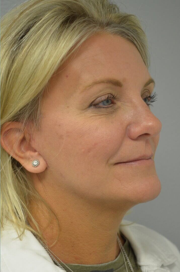 Face and Necklift After