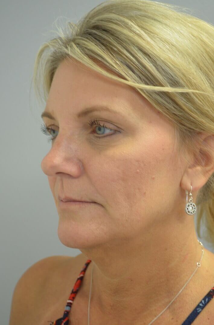 Face and Necklift Before