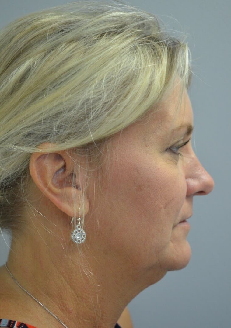 Face and Necklift Before