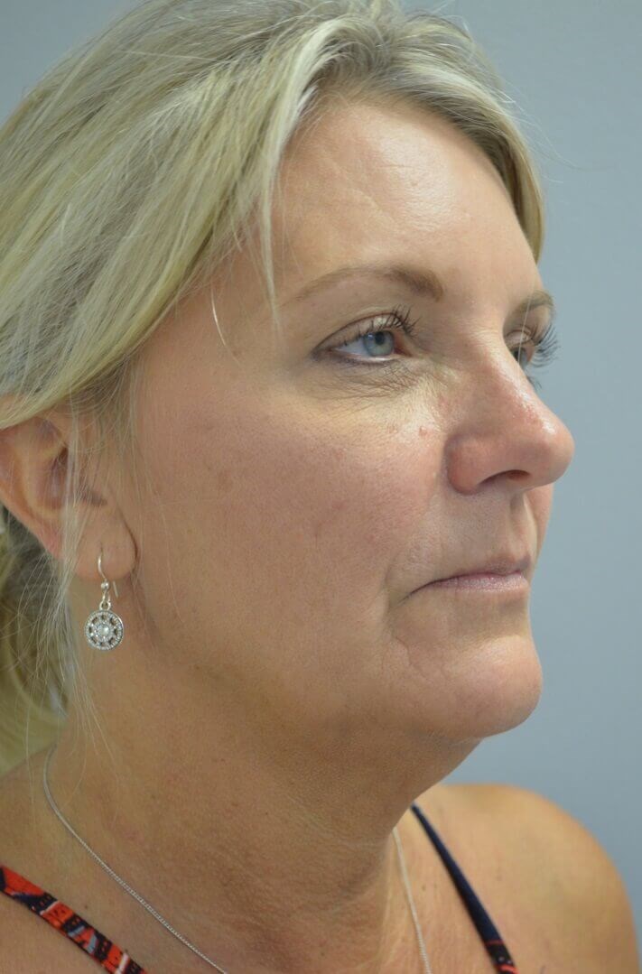 Face and Necklift Before