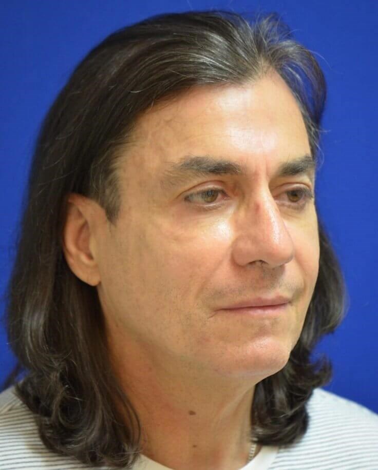 Male Facial Fat Grafting After