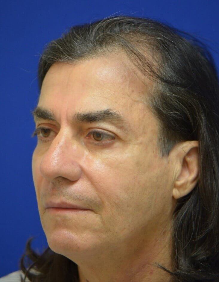 Male Facial Fat Grafting After