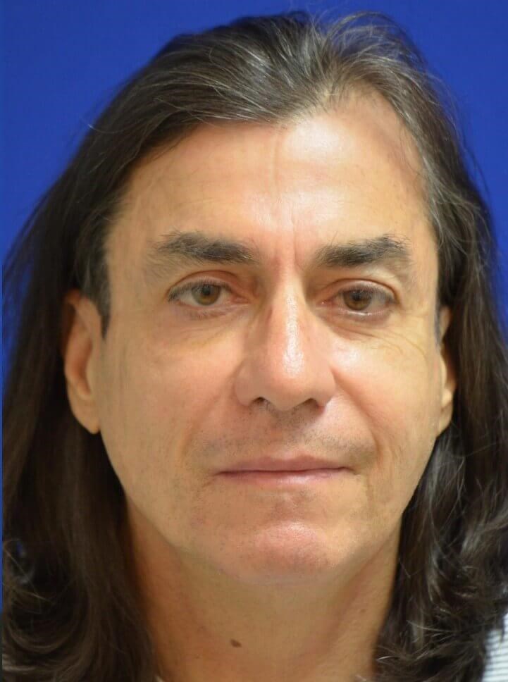 Male Facial Fat Grafting After
