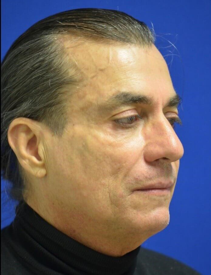 Male Facial Fat Grafting Before