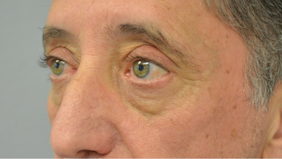 Upper Eyelid Lift Left Oblique After