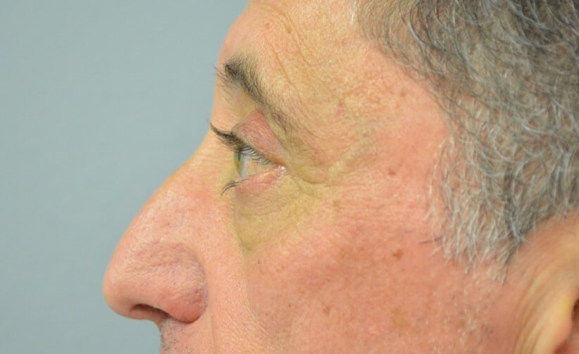 Upper Eyelid Lift Left Side After