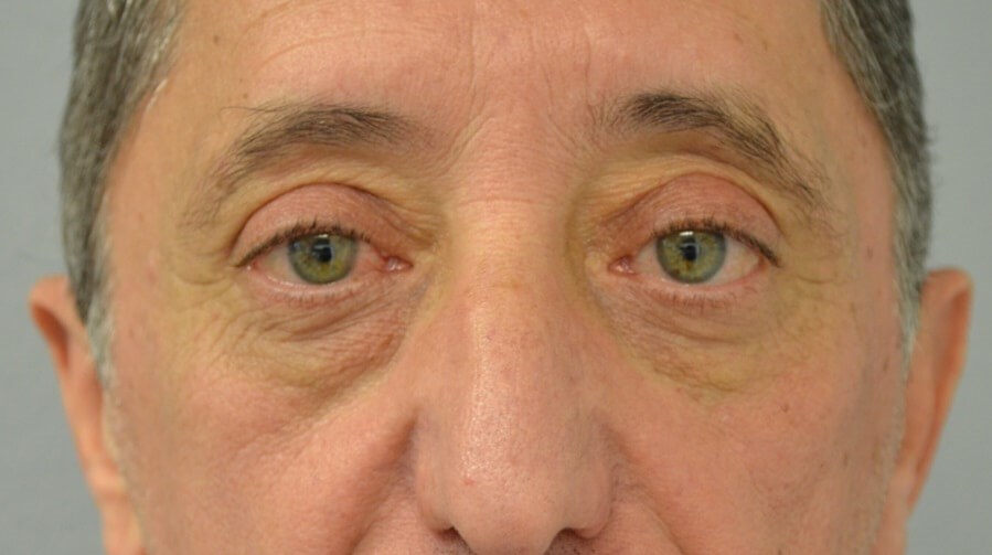 Upper Eyelid Lift Front After