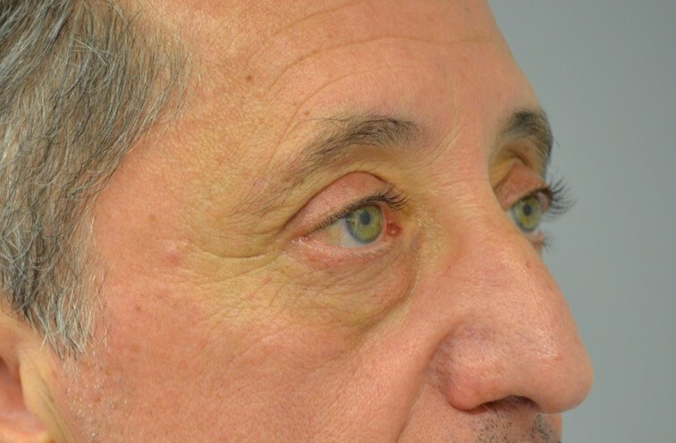 Upper Eyelid Lift Right Obliqu After