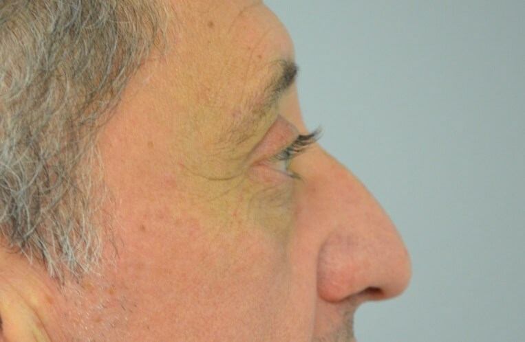 Upper Eyelid Lift Right Side After