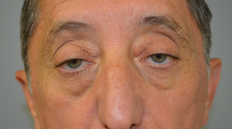 Upper Eyelid Lift Front Before