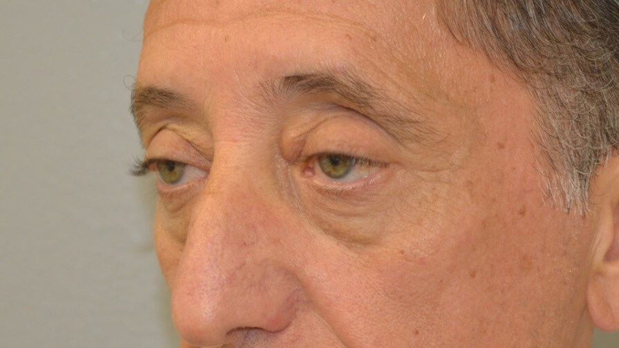 Upper Eyelid Lift Left Oblique Before