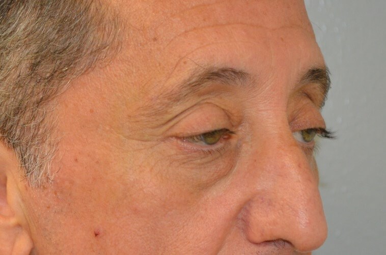 Upper Eyelid Lift Right Obliqu Before