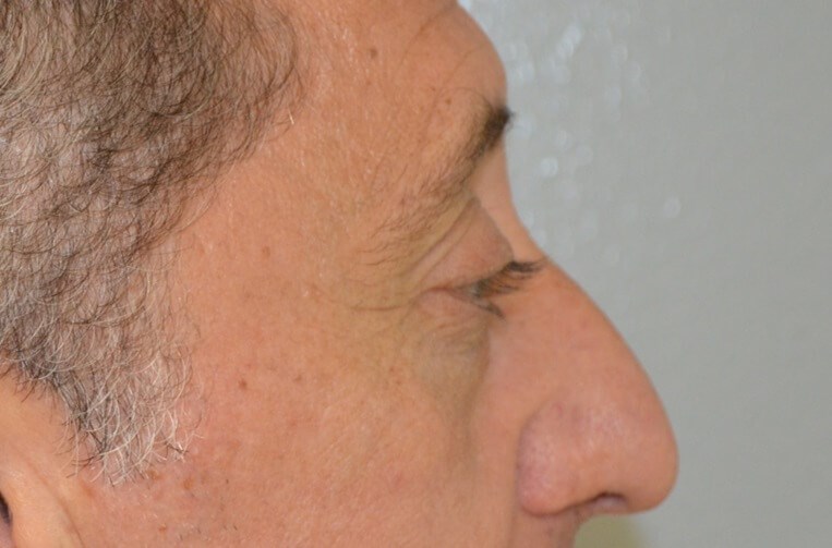 Upper Eyelid Lift Right Side Before