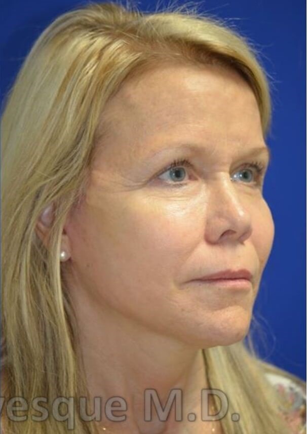 Face/Necklift and fat grafting After