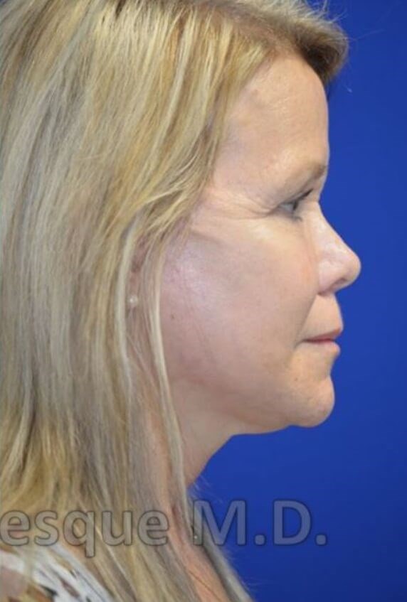 Face/Necklift and fat grafting After