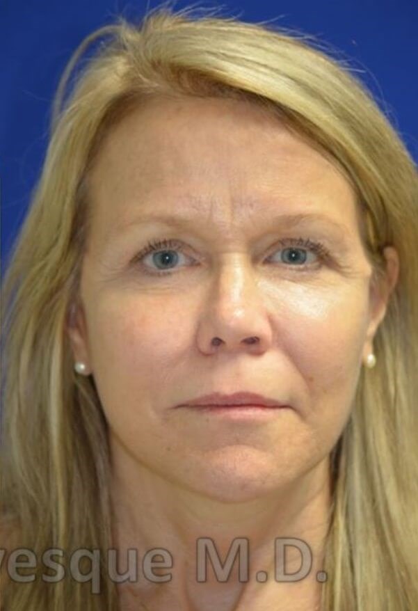 Face/Necklift and fat grafting After
