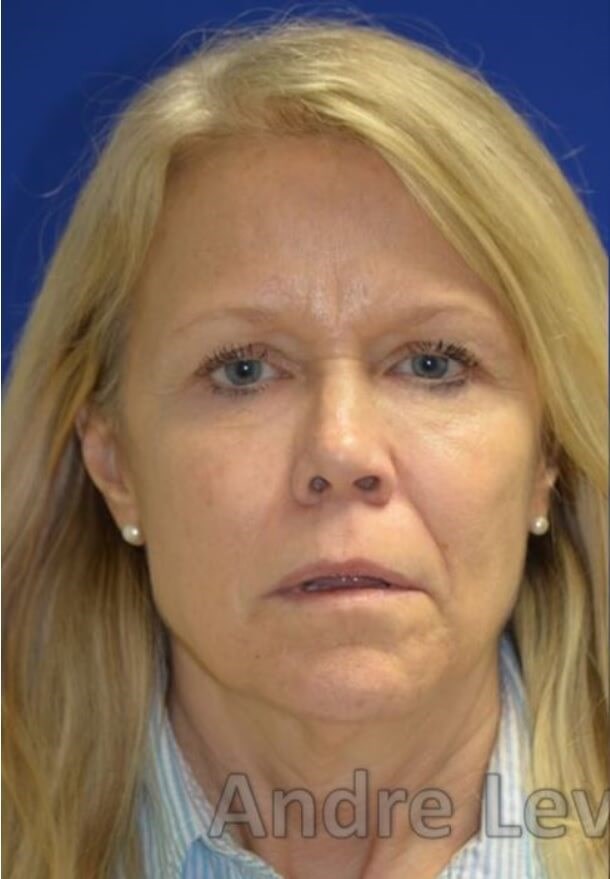 Face/Necklift and fat grafting Before