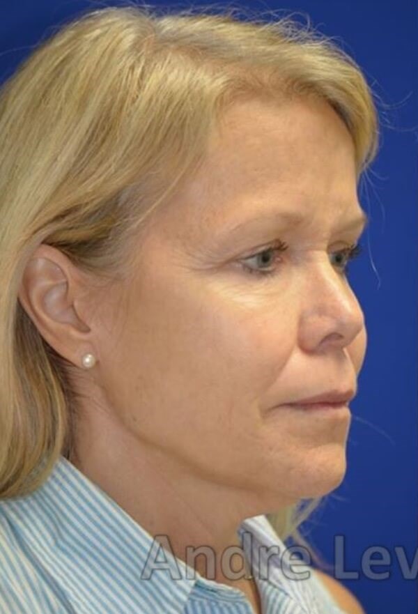 Face/Necklift and fat grafting Before