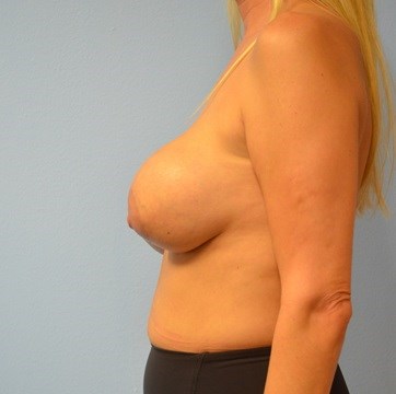 Breast Lift with new implants Before