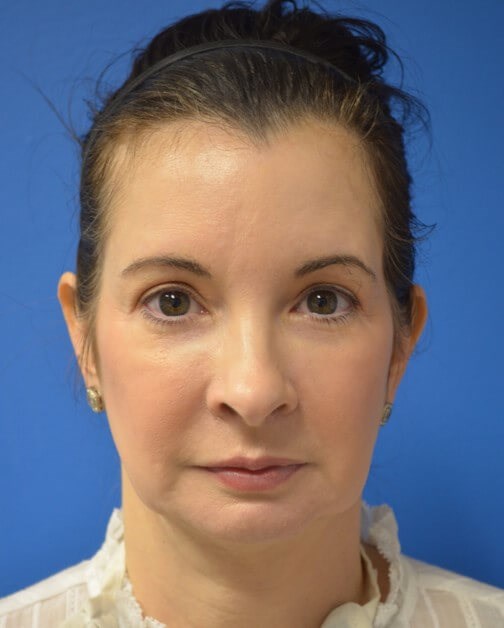 Deep plane Facelift Before