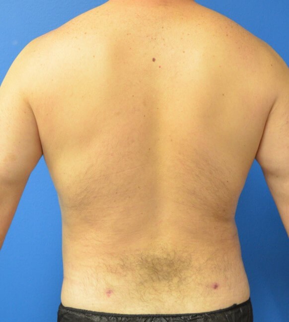 Male Lipo 360 in Austin After