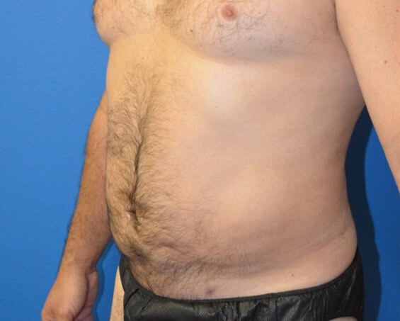 Male Lipo 360 in Austin After