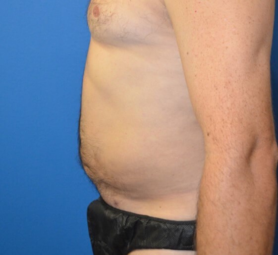 Male Lipo 360 in Austin After