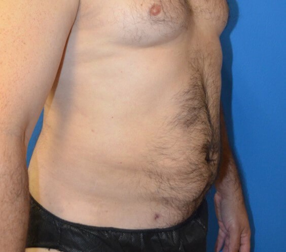 Male Lipo 360 in Austin After