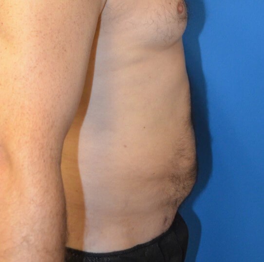 Male Lipo 360 in Austin After