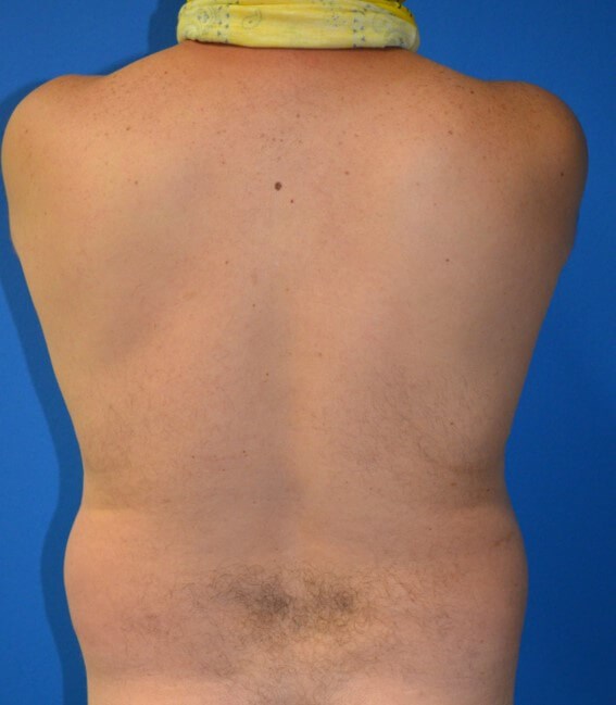 Male Lipo 360 in Austin Before
