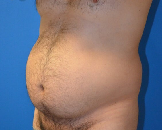 Male Lipo 360 in Austin Before