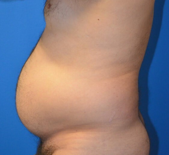 Male Lipo 360 in Austin Before
