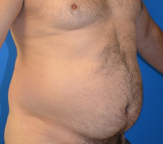Male Lipo 360 in Austin Before