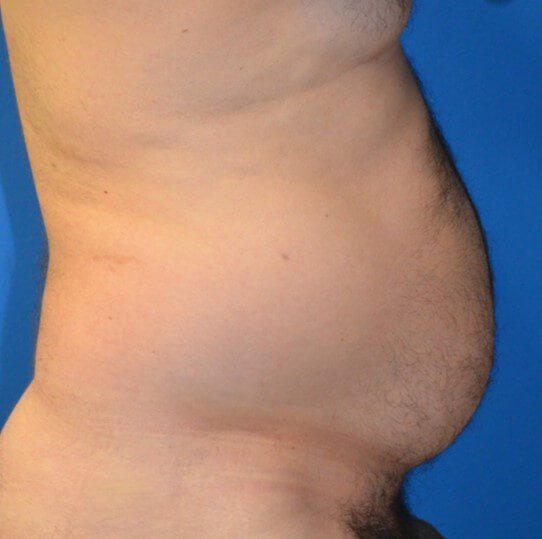 Male Lipo 360 in Austin Before