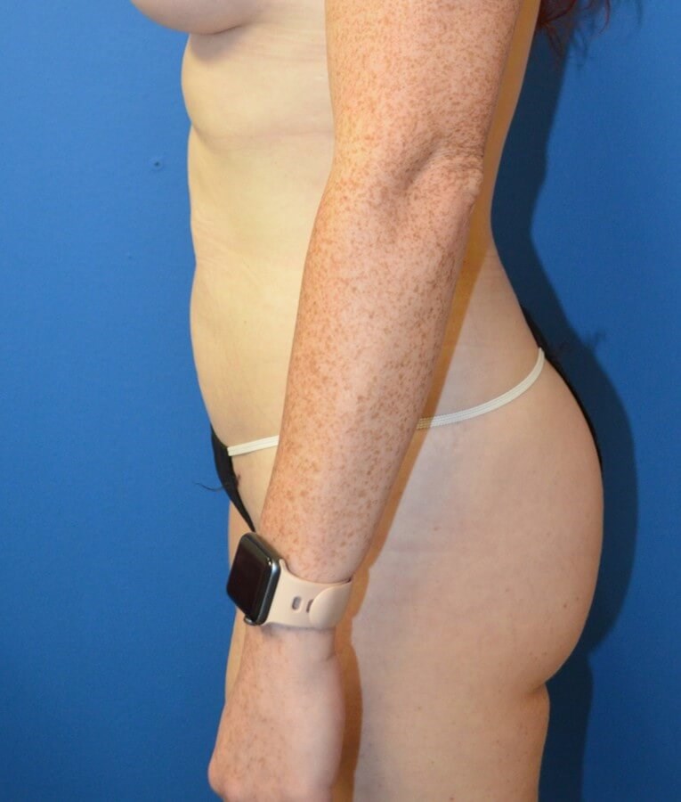 Fat transfer to buttocks/hips After