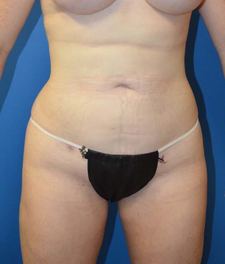 Fat transfer to buttocks/hips After