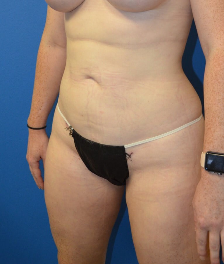 Fat transfer to buttocks/hips After